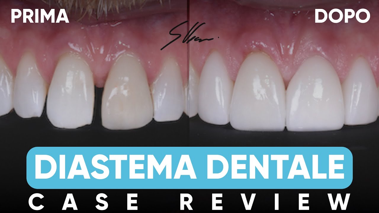 Diastema dentale: ecco come risolverlo