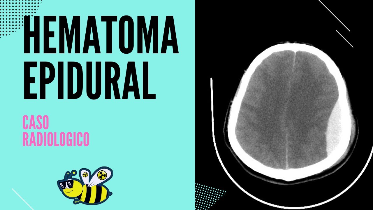 🛑🆕HEMATOMA EPIDURAL 🛑🆕