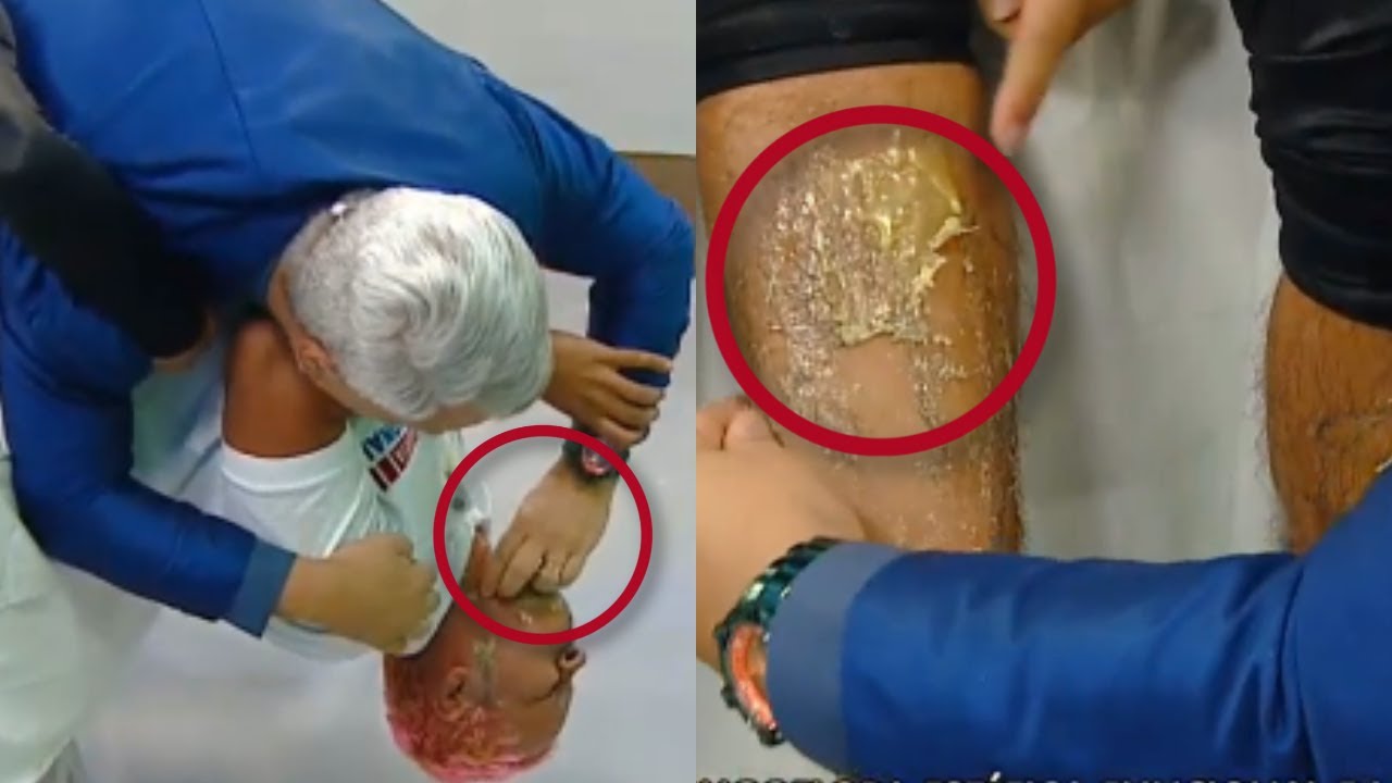 DEPILA&Ccedil;&Atilde;O COM CERA QUENTE NO TOALHA PODI E TOMMY GRETCHEN