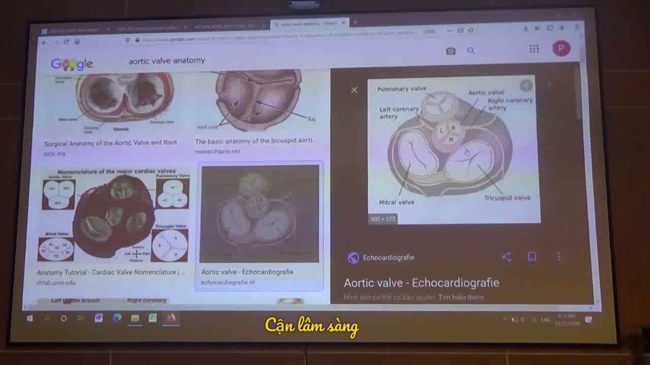 HỞ VAN ĐỘNG MẠCH CHỦ: ĐÁNH GIÁ TRÊN SIÊU ÂM 2D - DOPPLER THÀNH NGỰC | BS. Nguyễn Thị Hải Yến
