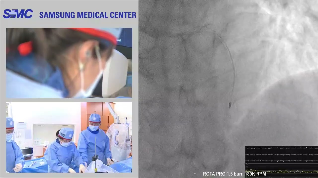 ENCORE SEOUL 2025 Live Demonstration (Calcified lesion)_Hyeon-Cheol Gwon, MD/PhD