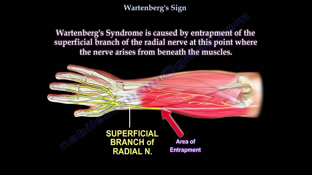 Wartenberg's Sign - Everything You Need To Know - Dr. Nabil Ebraheim