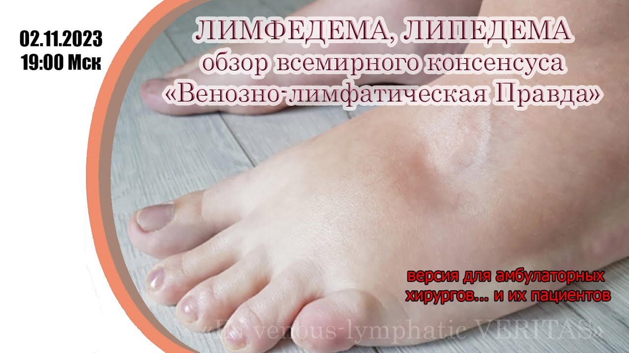 Липедема, лимфедема: обзор всемирного консенсуса 