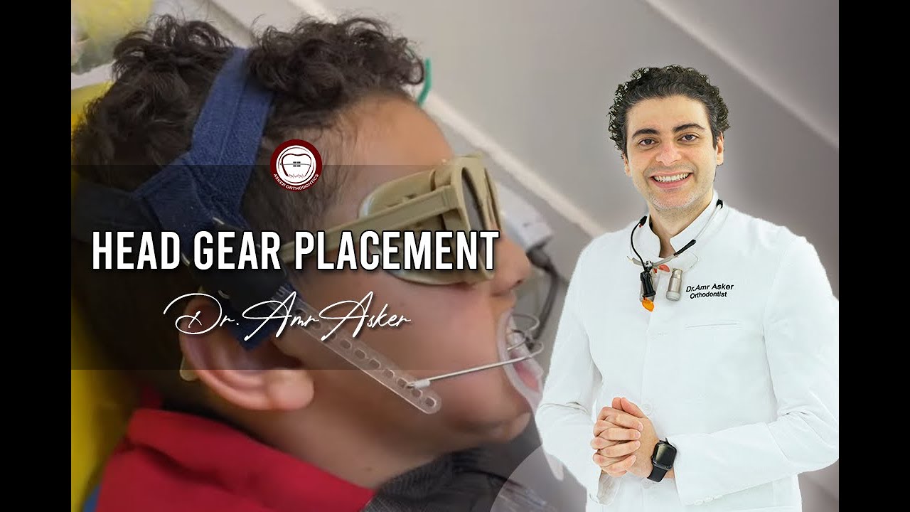Head gear placement in orthodontics facebow high pull+activator in class II skeletal Dr. Amr Asker