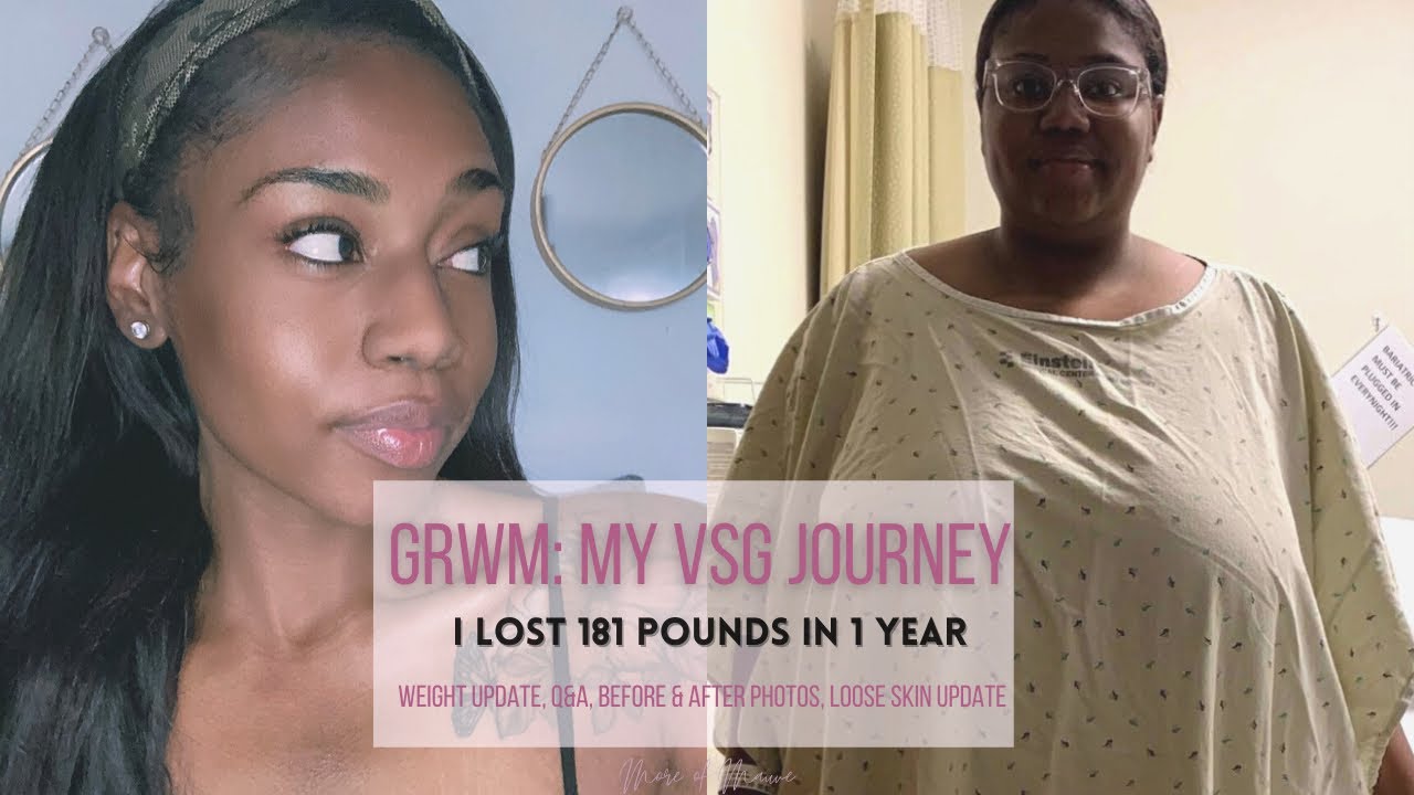 VSG Journey: I Lost 181 POUNDS in a year! Post-Op Update, Weight Loss Story, Loose Skin, Q&A | Mauve