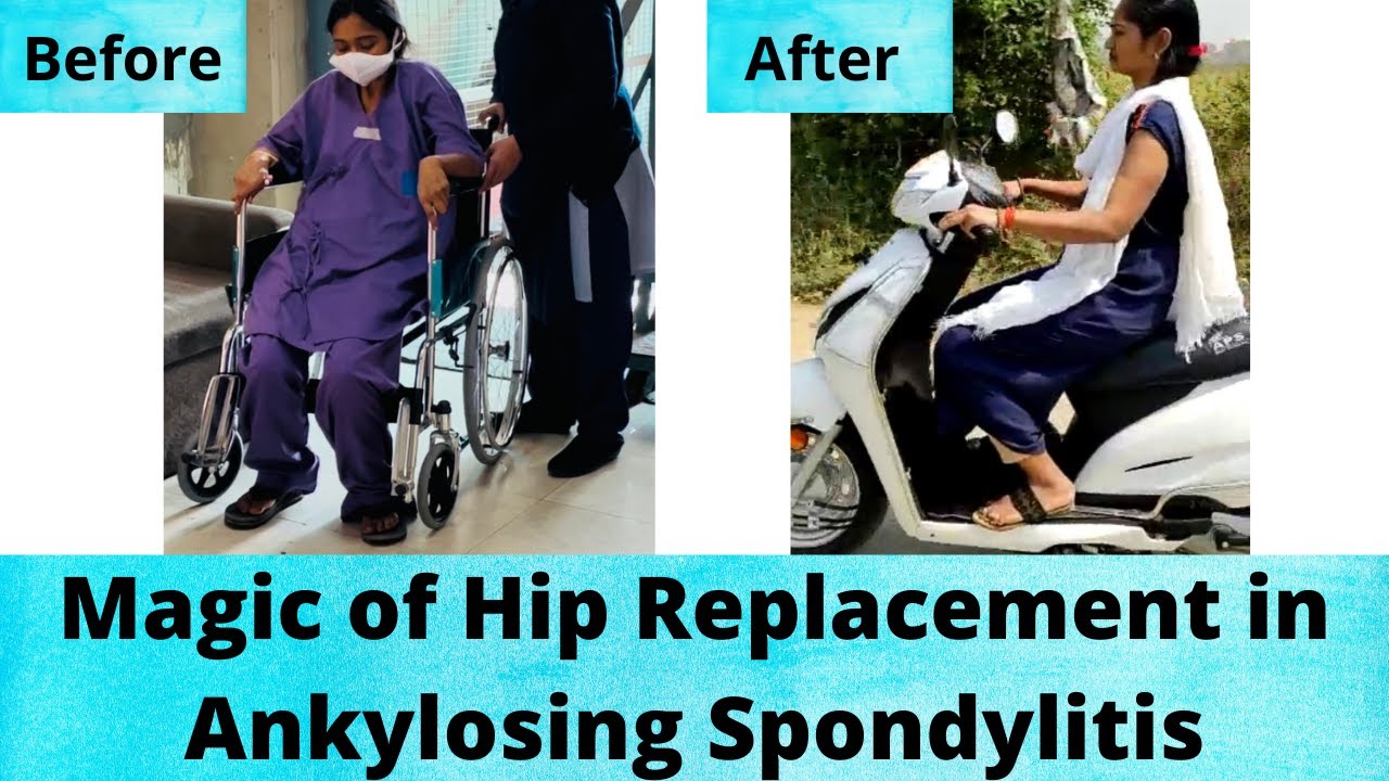 Replacement of BOTH HIPS in Ankylosing Spondylitis