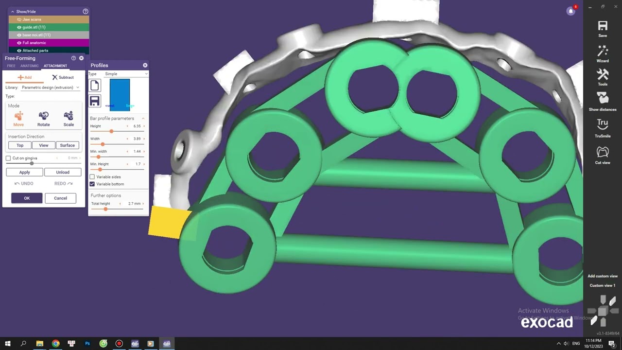 Các bước thiết kế Stackable guide all on X bằng exocad và exoplan