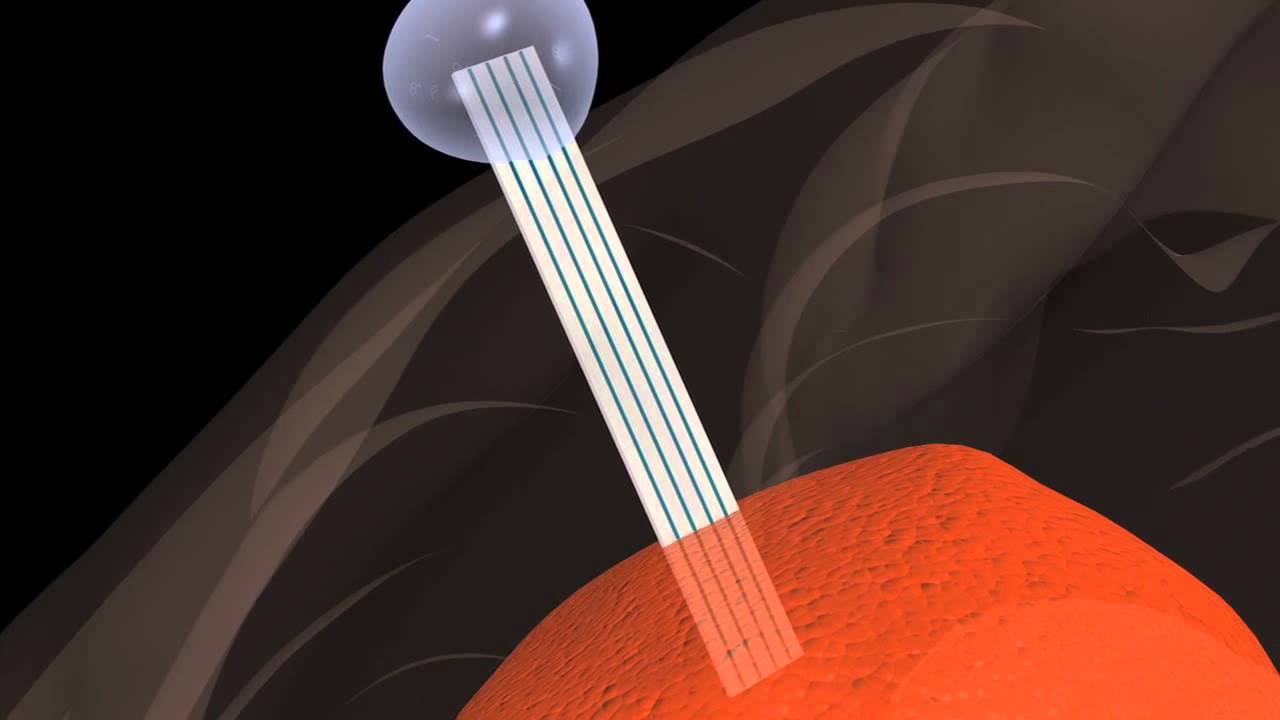 Gliobastoma exvasion concept