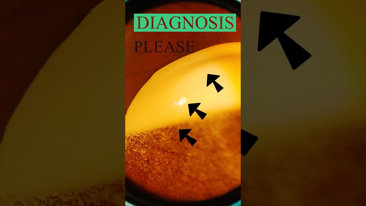 Diabetic retinopathy | Vitreous | Hard exudates | Fundus | Short Video 193
