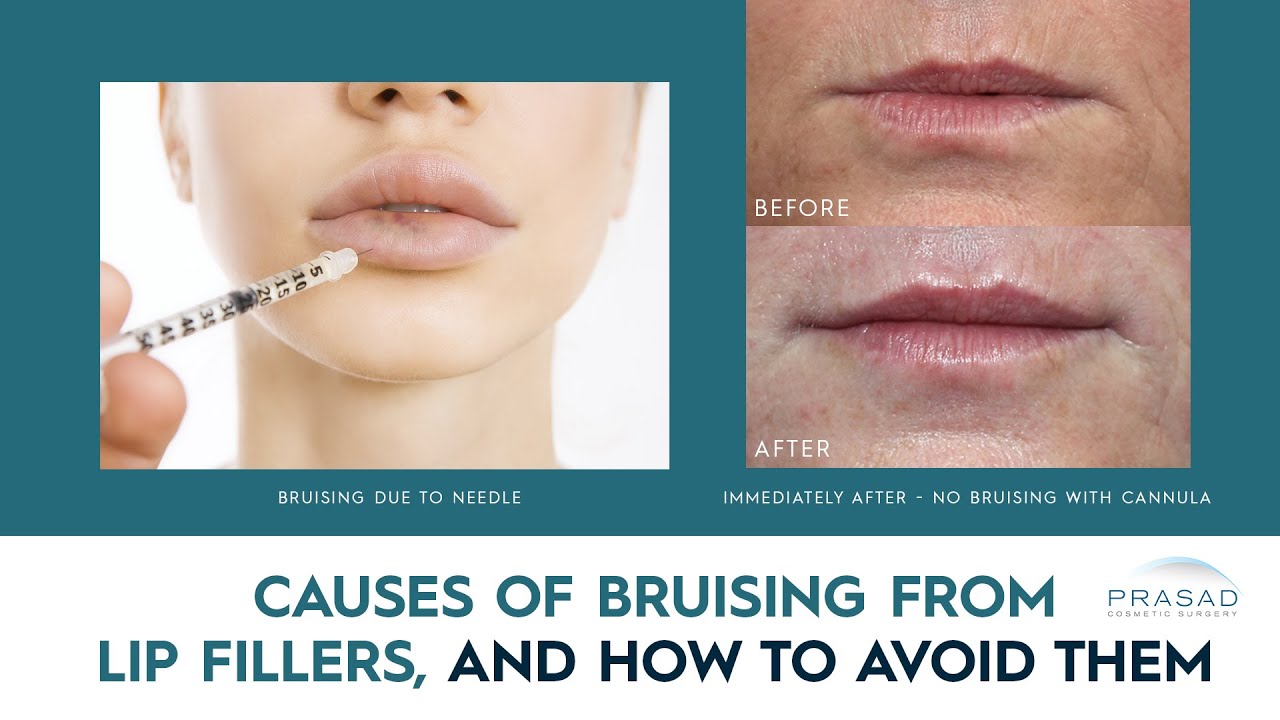 Causes of Bruising and Swelling from Lip Filler Treatment, and How they Can be Avoided