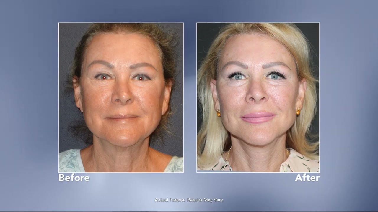 How to Look Years Younger with a Natural-Looking Facelift | Expert Plastic Surgeon Explains