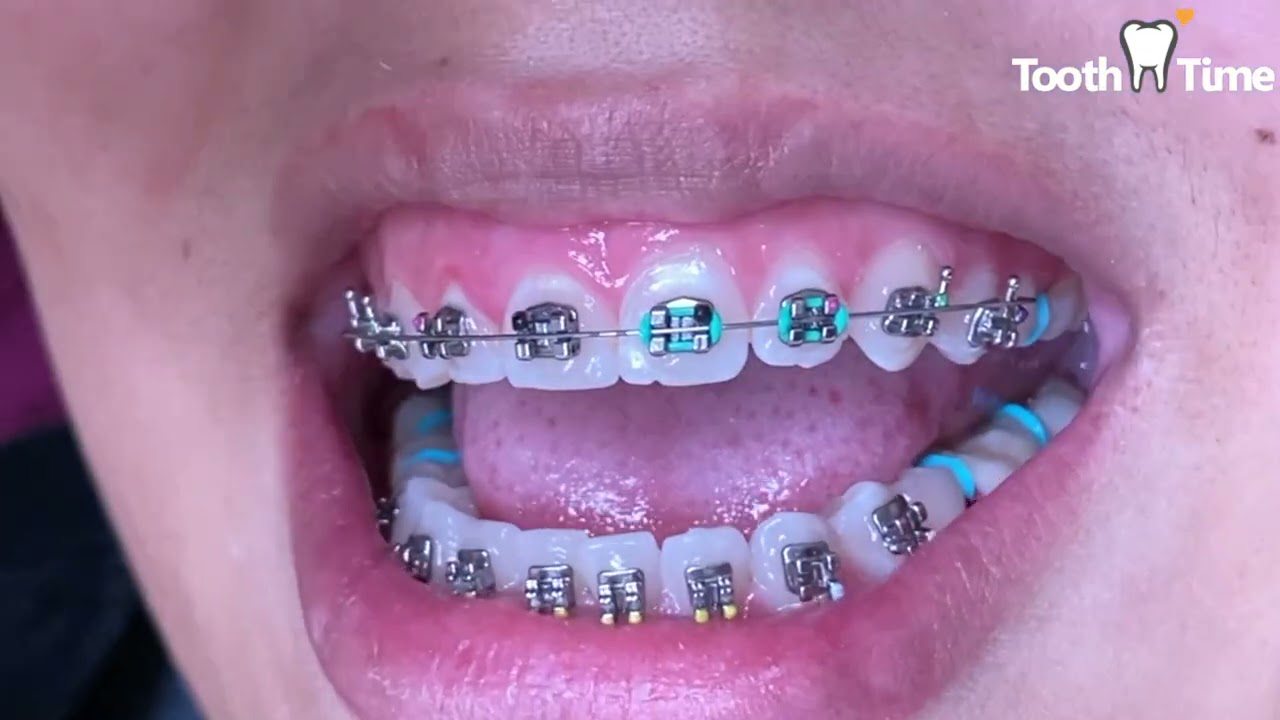 How to avoid getting braces again - braces on - Tooth Time Family Dentistry New Braunfels