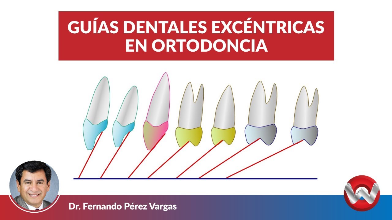 Guías Dentales Excéntricas en Ortodoncia