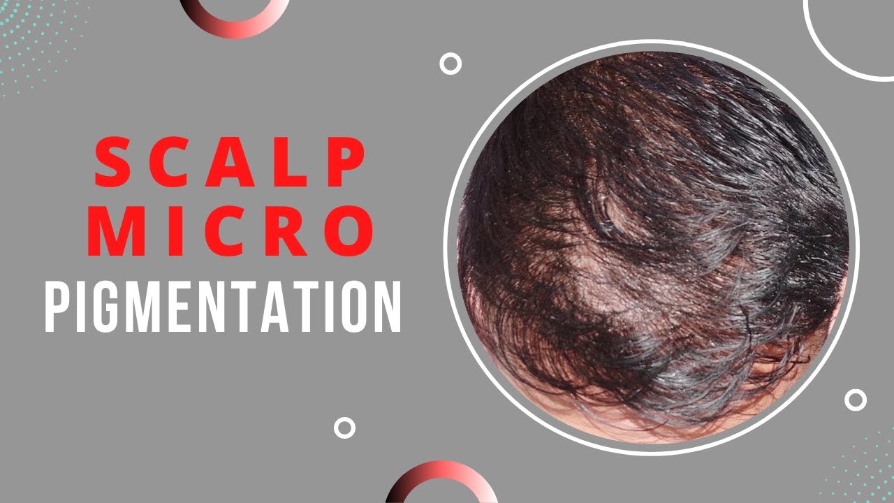 Scalp Micro Pigmentation (SMP) | SMP Treatment | Hair Destination | Part-2