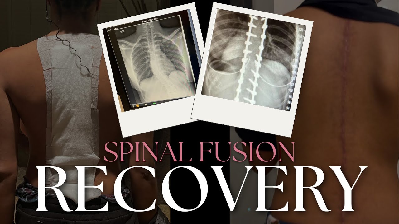 Life After Scoliosis Surgery: 1 Week Vlog + 1 Month Update! (The Real Recovery Journey)