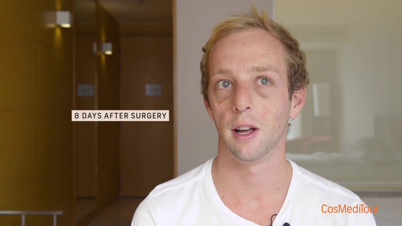 RHINOPLASTY RESULT - COSMEDITOUR THAILAND