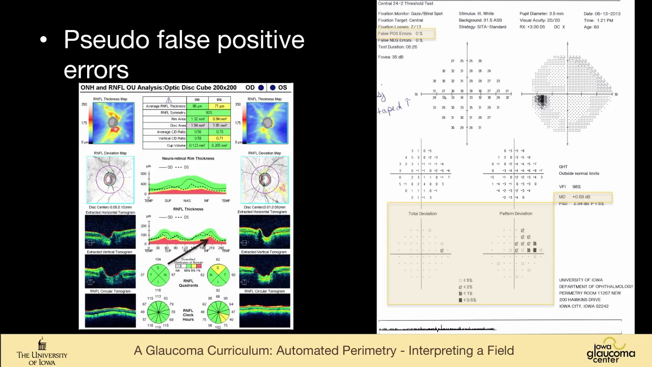 6 EXAMINATION Automated Perimetry   Interpreting a Field