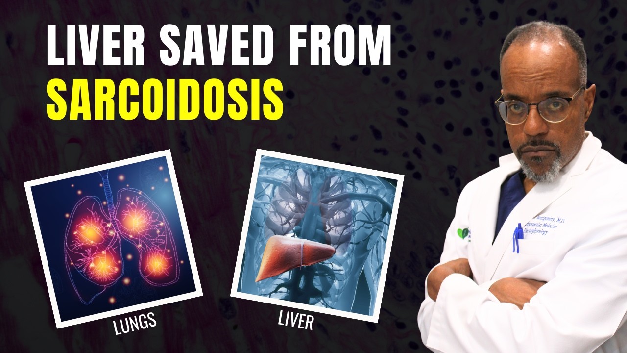 52-year-old with sarcoidosis removed from liver transplant list after rapid health reversal