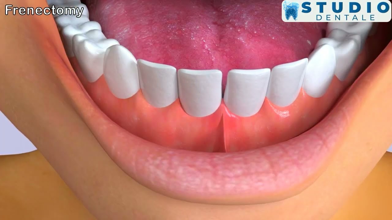 Frenectomy: Freedom for Your Smile! 🌟🦷