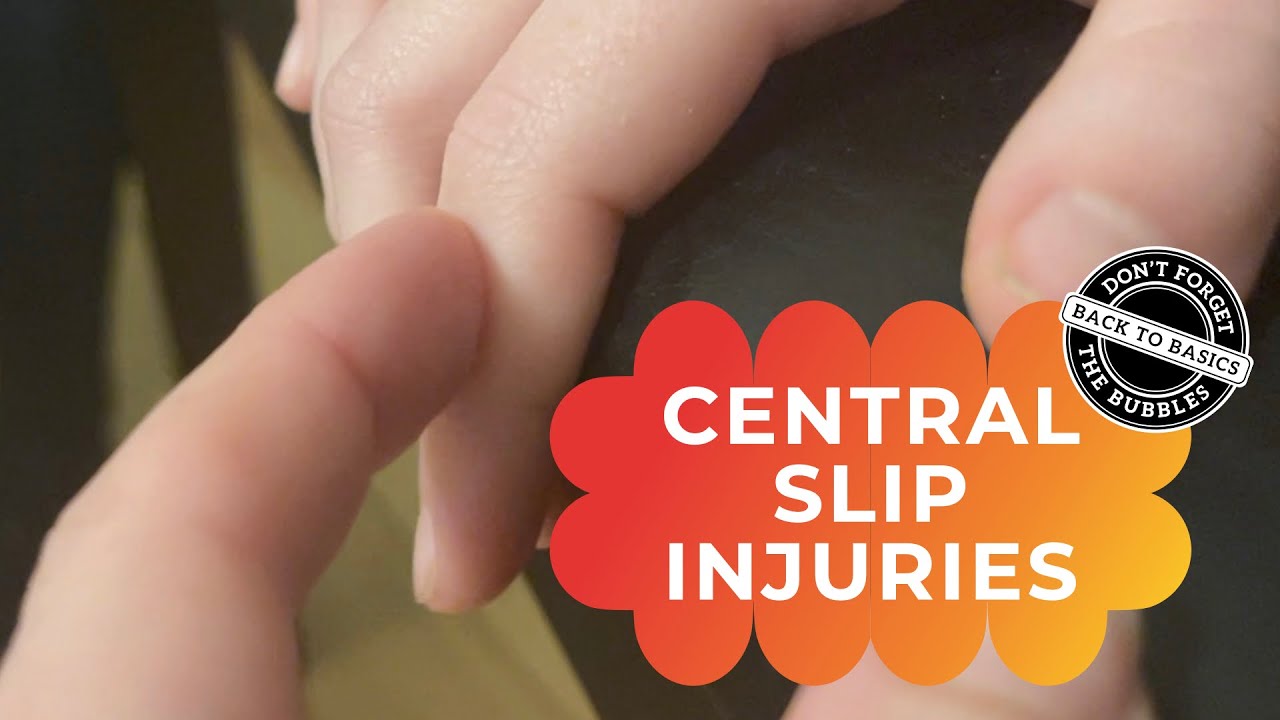 Central slip injuries - a Zone 3 finger extensor tendon injury