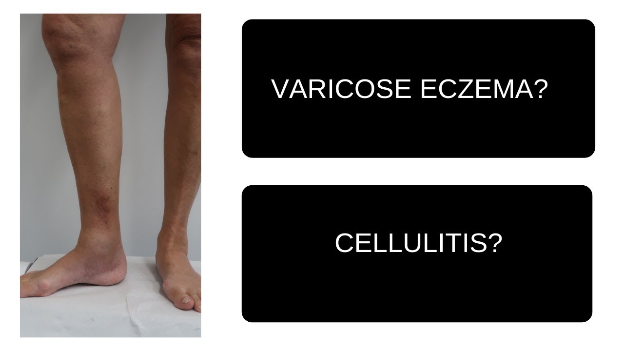 Varicose Eczema | Cellulitis | Which is it?