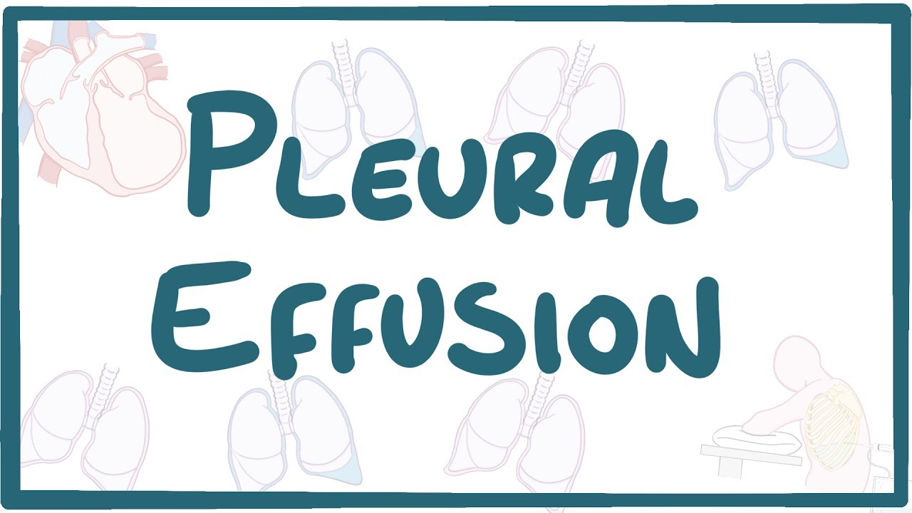 Pleural Effusion - causes, symptoms, diagnosis, treatment, pathology