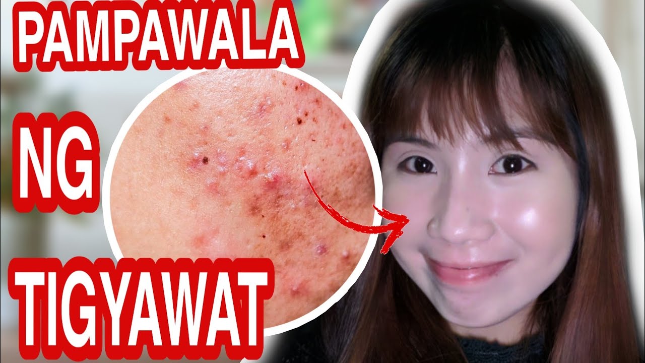TANGGAL PIMPLES AND PIMPLE MARKS? | Precious skin 3 in 1 Bentonite Clay Mask and Miracle Cream