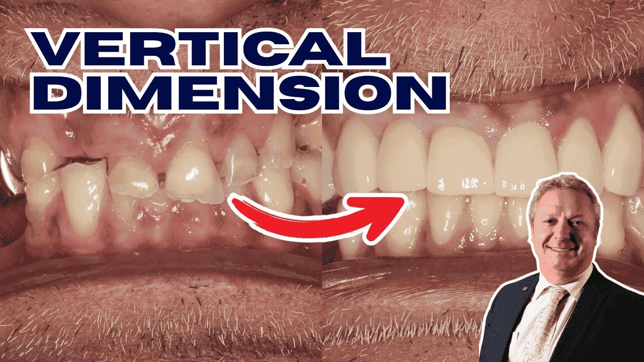 Steps for Increasing the Vertical Dimension of Occlusion with David Bloom - PDP232