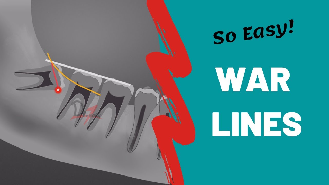 WAR Lines | Хирургия полости рта | Бесплатные заметки