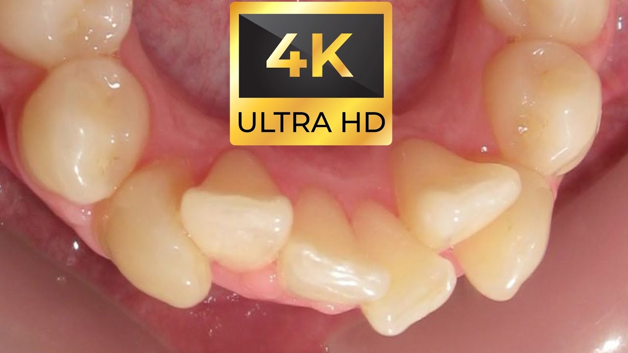 HOW BRACES WORK! Crowding and Lingual #braces #incognito
