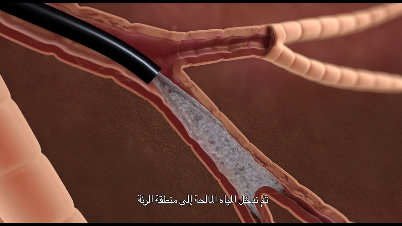 تنظير القصبات الهوائية التشخيصي