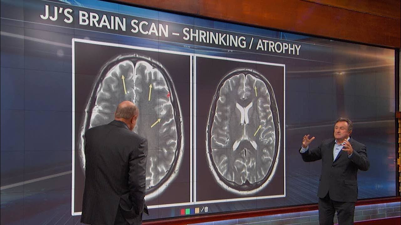 A Look Inside The Brain Of A Drug User