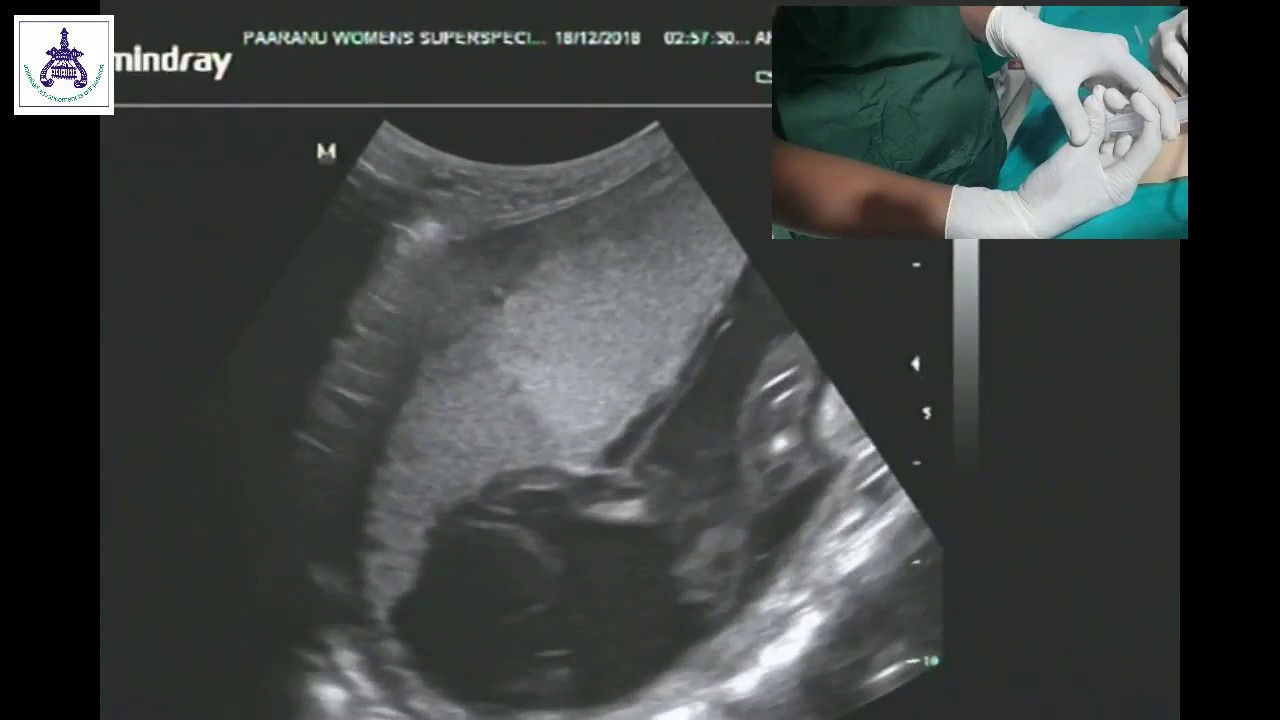 Intrauterine Transfusion IUT Procedure at Paaranu IVF by Dr. Jayesh Patel, Surat, Gujarat, India.