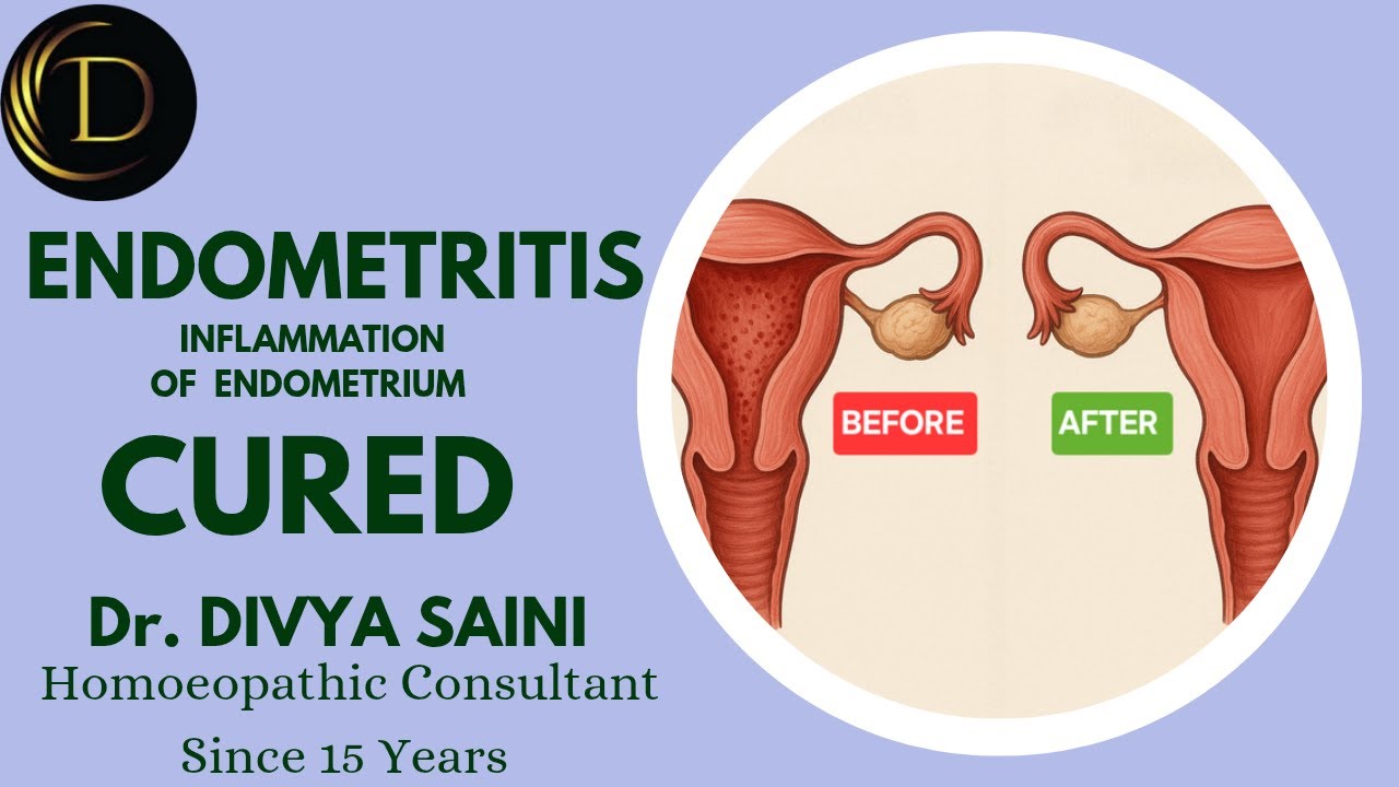 Endometritis Cured | Homeopathic Treatment | Divya Homoeo Clinic | Roorkee | Uttarakhand