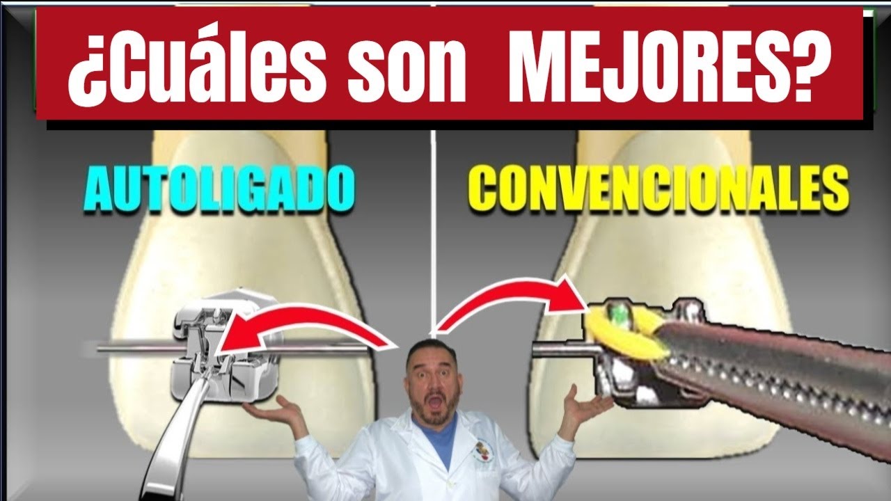 ¿Los Brackets de Autoligado son Mejores que otros? Descúbrelo aquí!