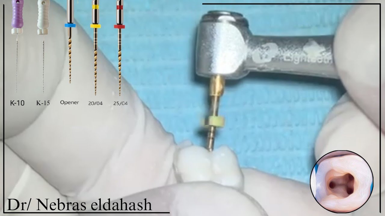 Root Canal Preparation by Rotary File's.
