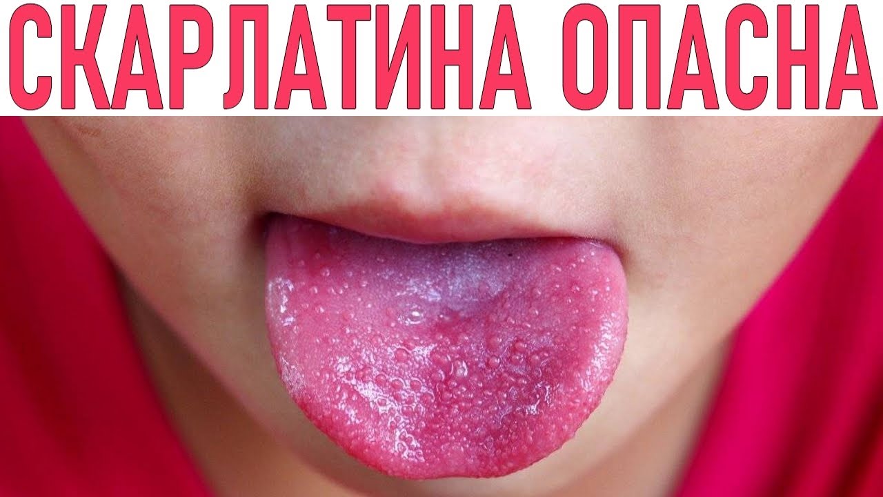 СКАРЛАТИНА У ДЕТЕЙ | Симптомы, лечение и диагностика