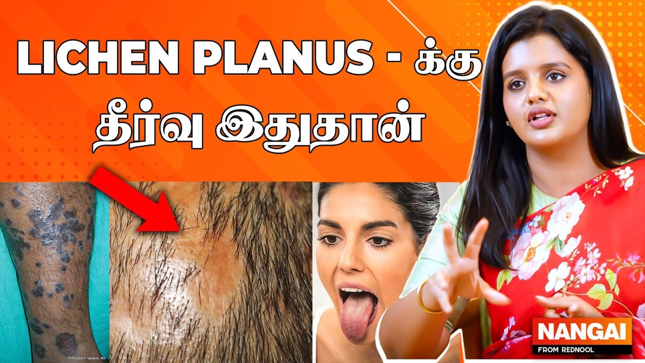 இந்த Symptoms இருந்தா கண்டிப்பா Doctor கிட்ட போங்க - Dermatologist Dr. Poornima MD  | Lichen Planus