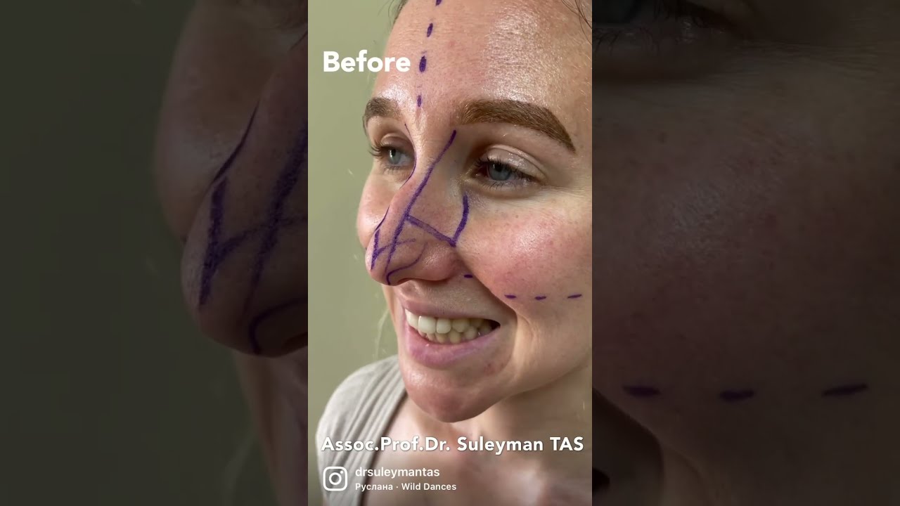 Nose Job Before & 7 Days After | Crooked & Projected Nose