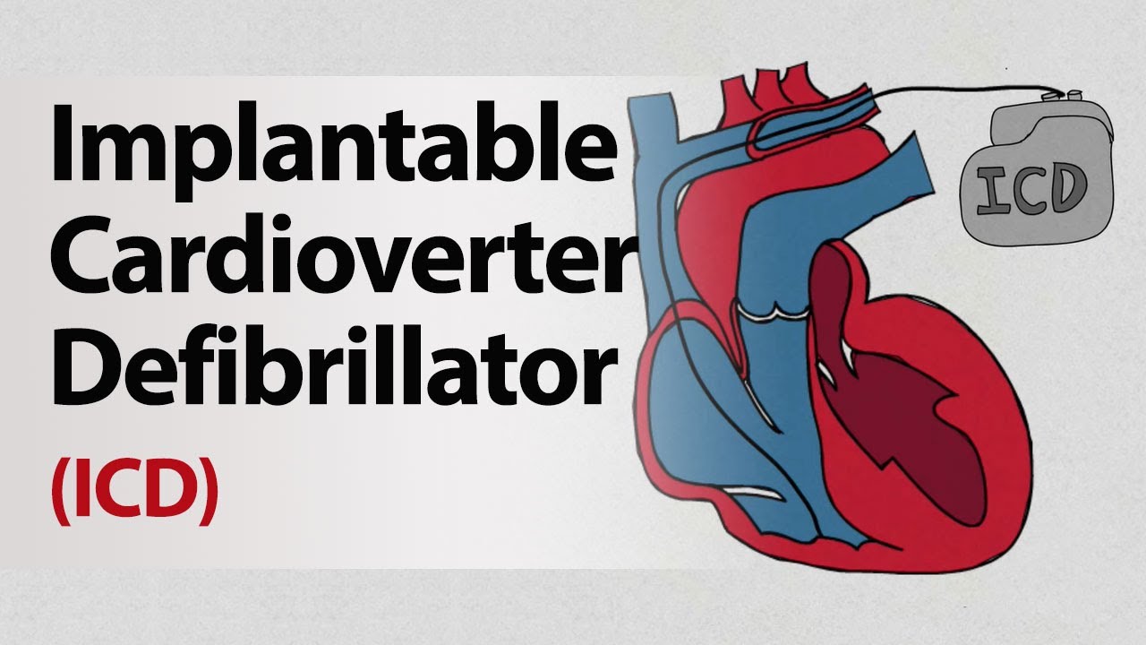 Implantable Cardioverter Defibrillator ICD