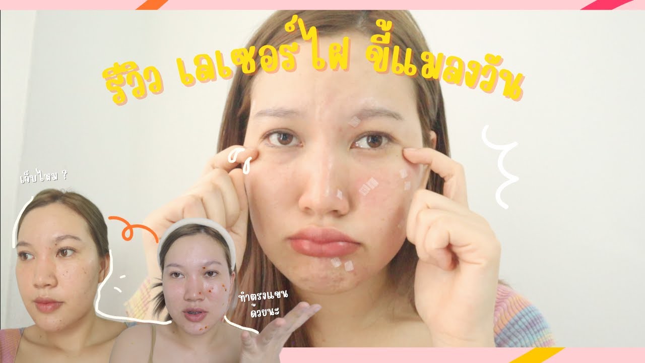 รีวิว เลเซอร์ไฝ ขี้แมลงวัน เหมาทั้งหน้าแค่ 1,000 บาท !! เจ็บไหม ทำยังไงบ้างบอกหมด l Loukkwang
