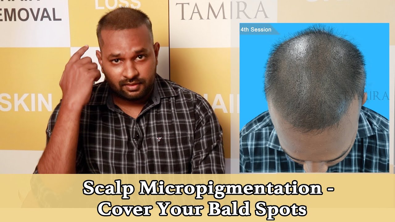 SCALP MICROPIGMENTATION - Cover Your Bald Spots(BEFORE AND AFTER )at Tamira in Chennai