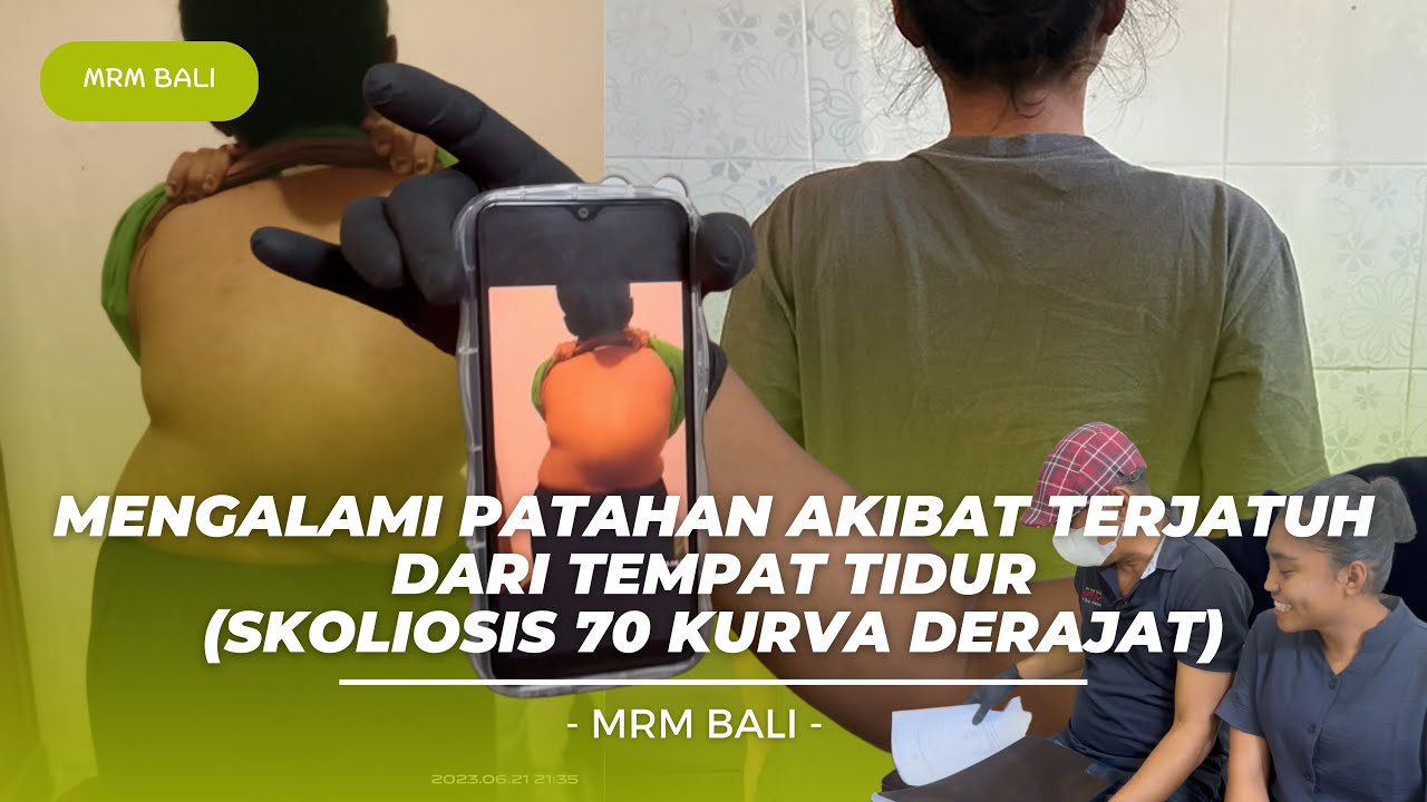 MRM BALI | Mengalami Patahan Akibat Terjatuh dari Tempat Tidur - (Skoliosis 70 Kurva Derajat)