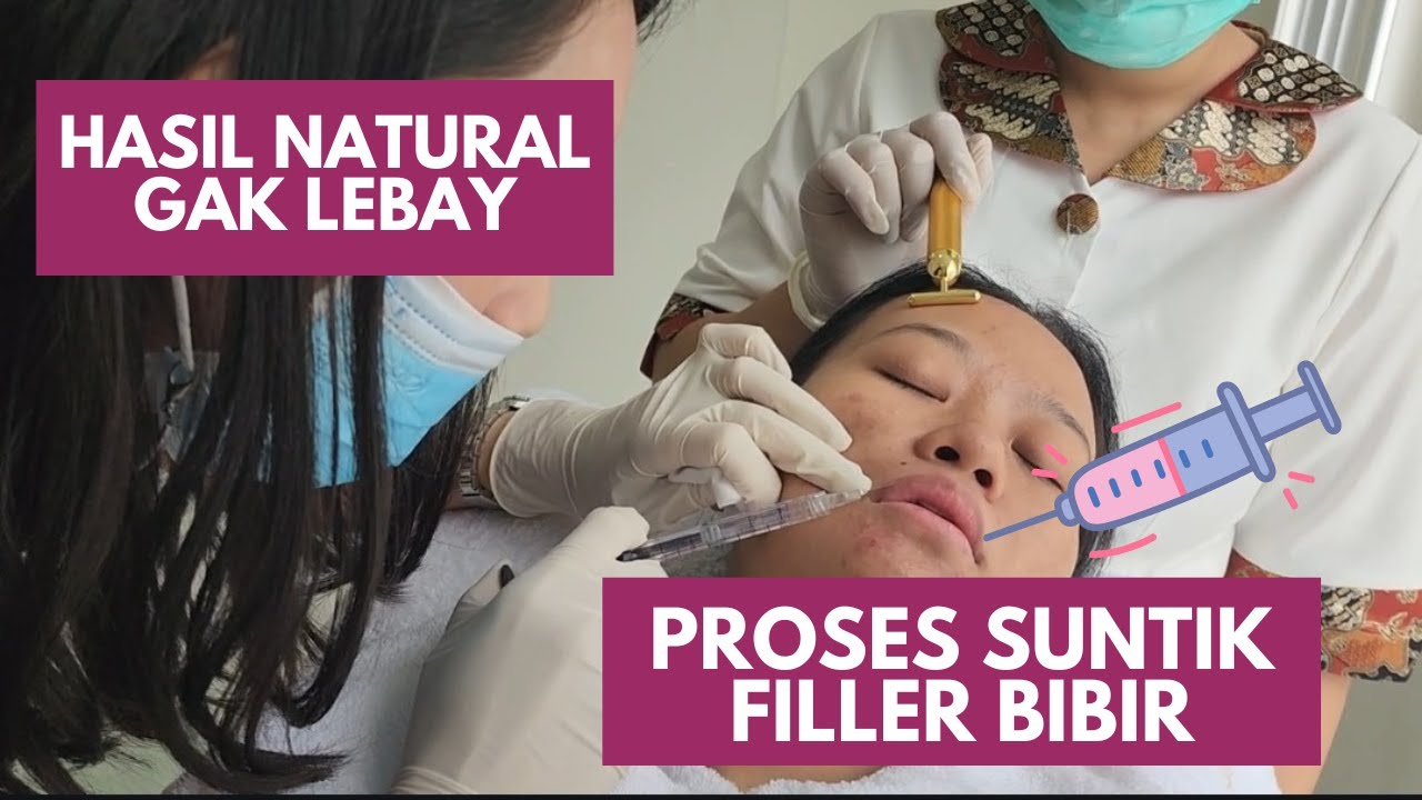 Filler Bibir Before After (Pakai Filler KHUSUS Bibir) - Hasil INSTAN