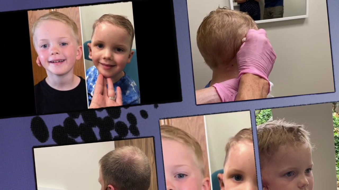 Microtia ear surgery through the eyes of 4 year old Myles