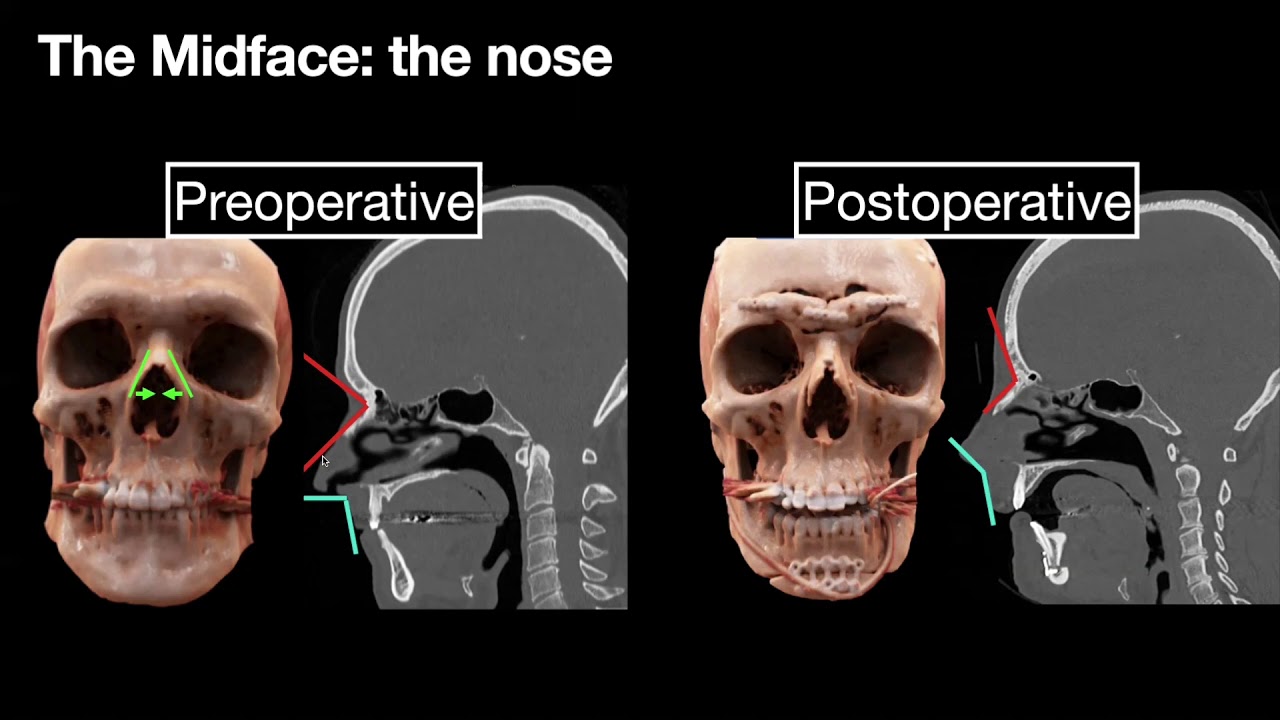 Facial Feminization Surgery: Key CT Findings for Preoperative Planning and Postoperative Evaluation