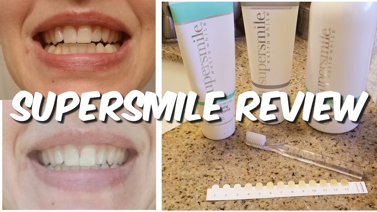 SUPERSMILE WHITENING REVIEW | At Home Teeth Whitening System Honest Review