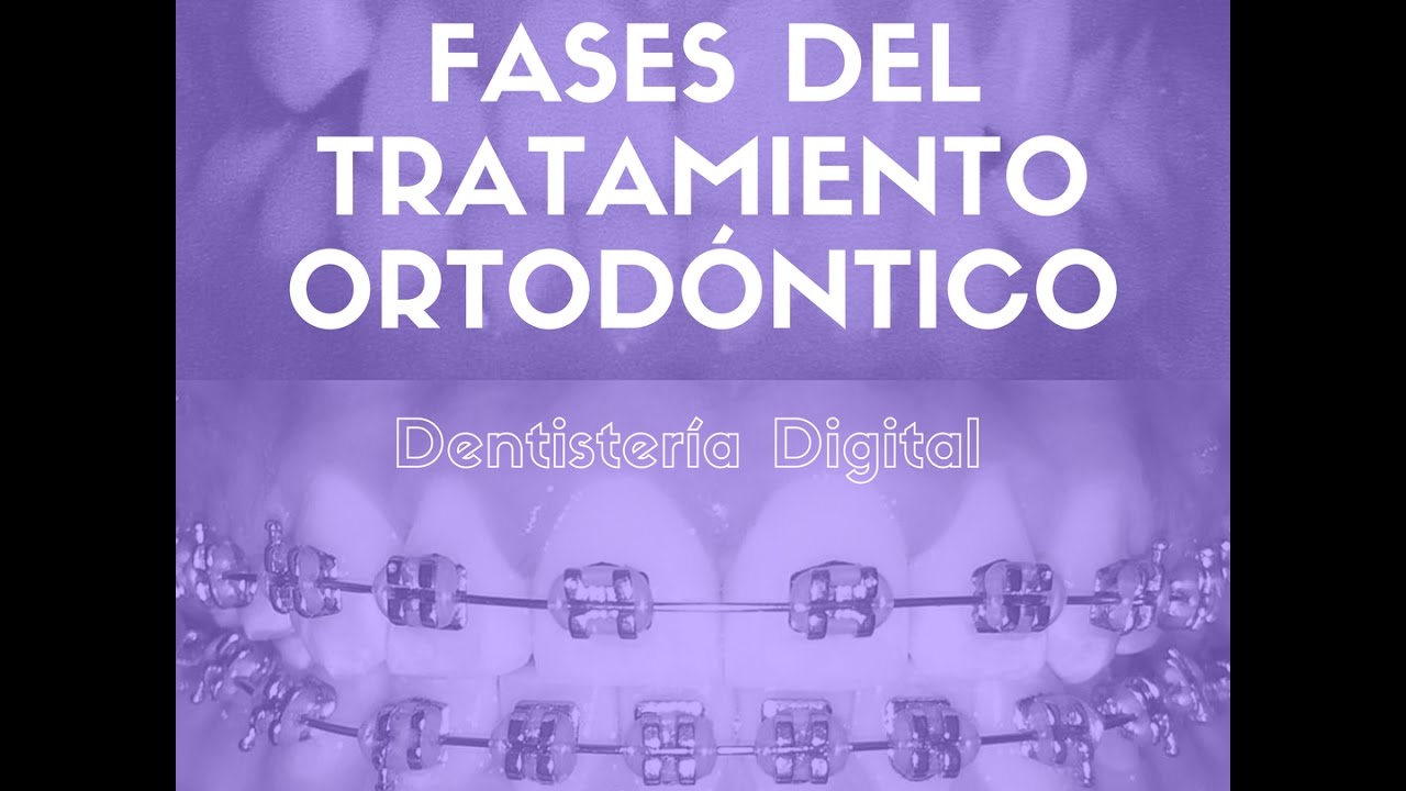 BRACKETS - Fases del tratamiento de Ortodoncia / BRACES - Orthodontics Treatment Phases