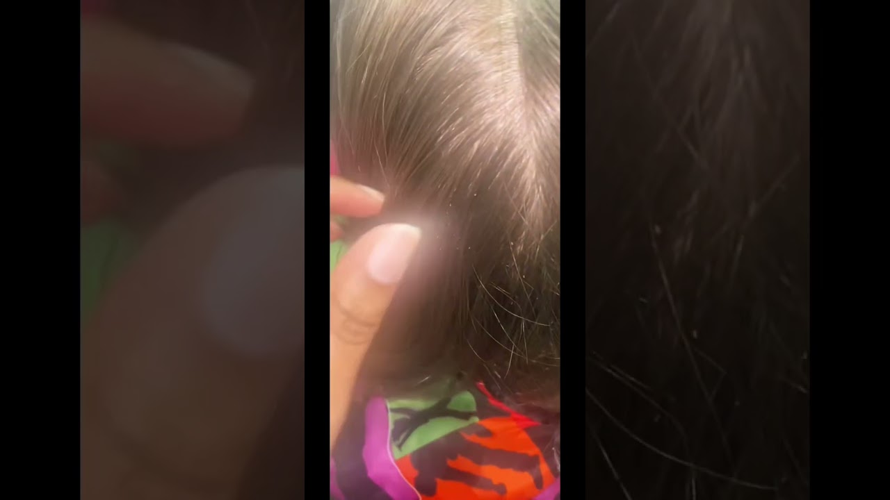 Nits on brown hair #lice #piojos #nitpicking #nits