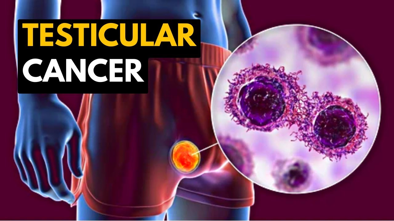 Testicular Cancer, Causes, Signs and Symptoms, Diagnosis and Treatment.